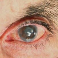 Glaucoma clinics run on Moorfields app