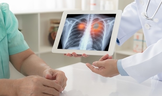 New £11m programme to explore AI in lung cancer diagnosis