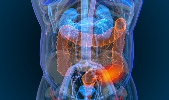 AI trial for bowel cancer care underway at 9 NHS trusts